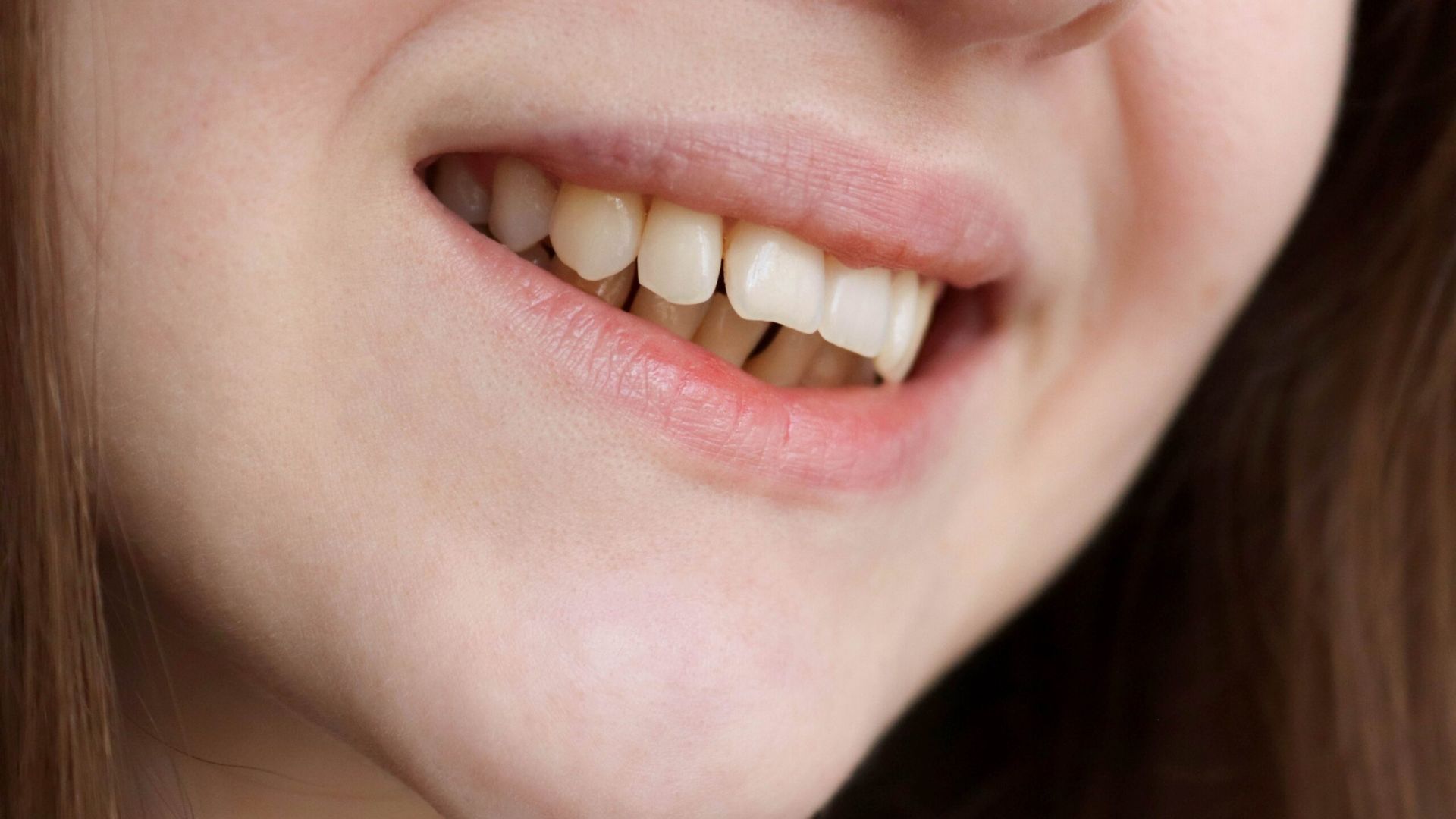 How to Fix an Overbite: Best Treatment Options With & Without Braces