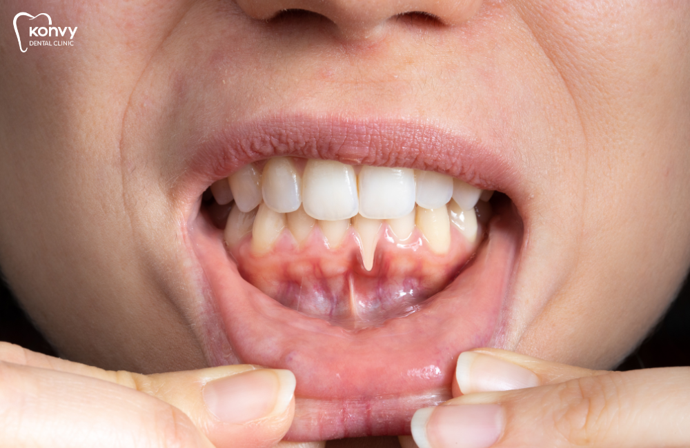 เหงือกร่น (Gum Recession) คืออะไร