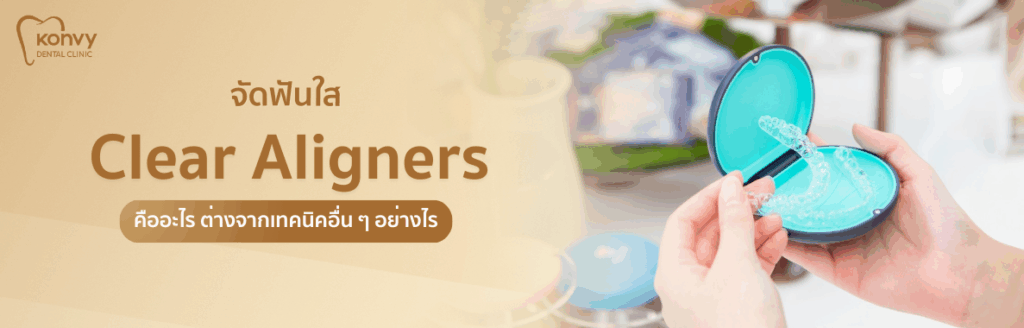 จัดฟันใส Clear Aligners คืออะไร