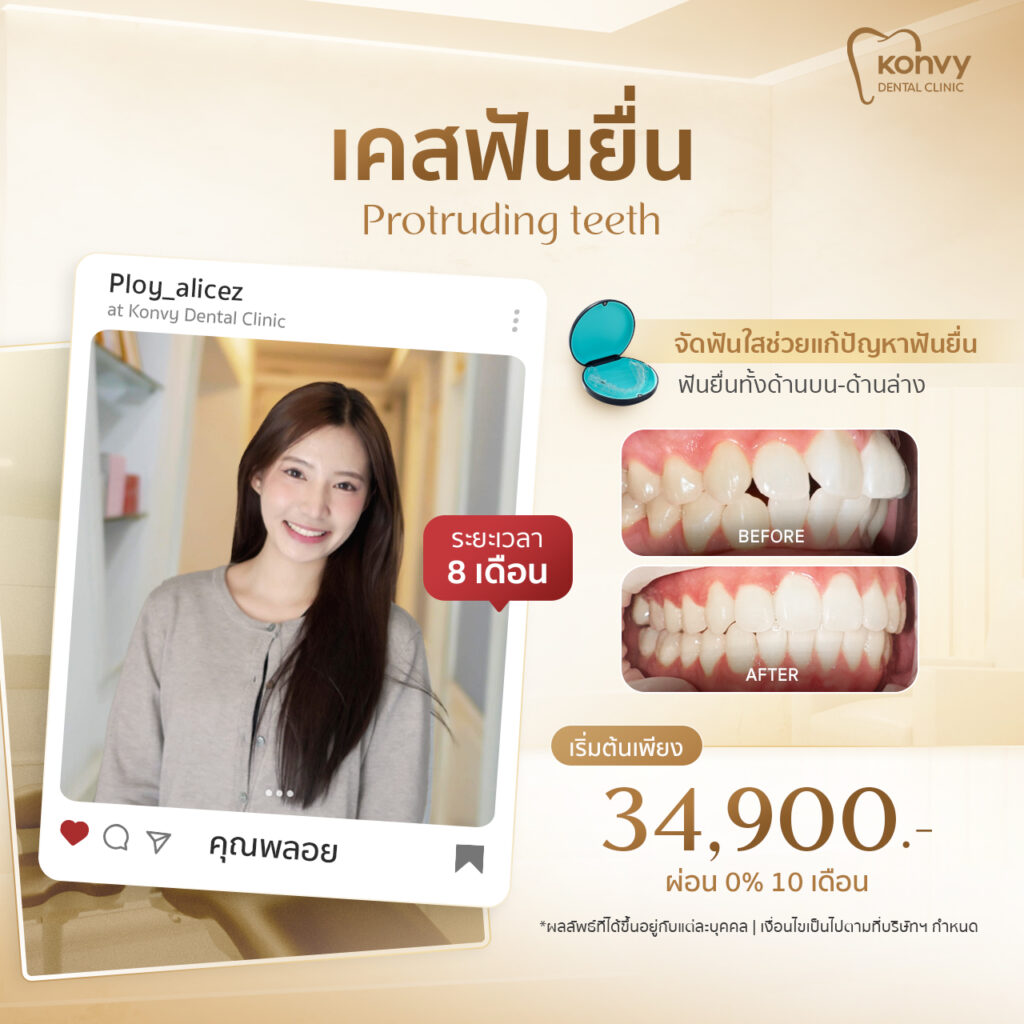 ฟันเรียงสวย ที่ Konvy Dental Clinic