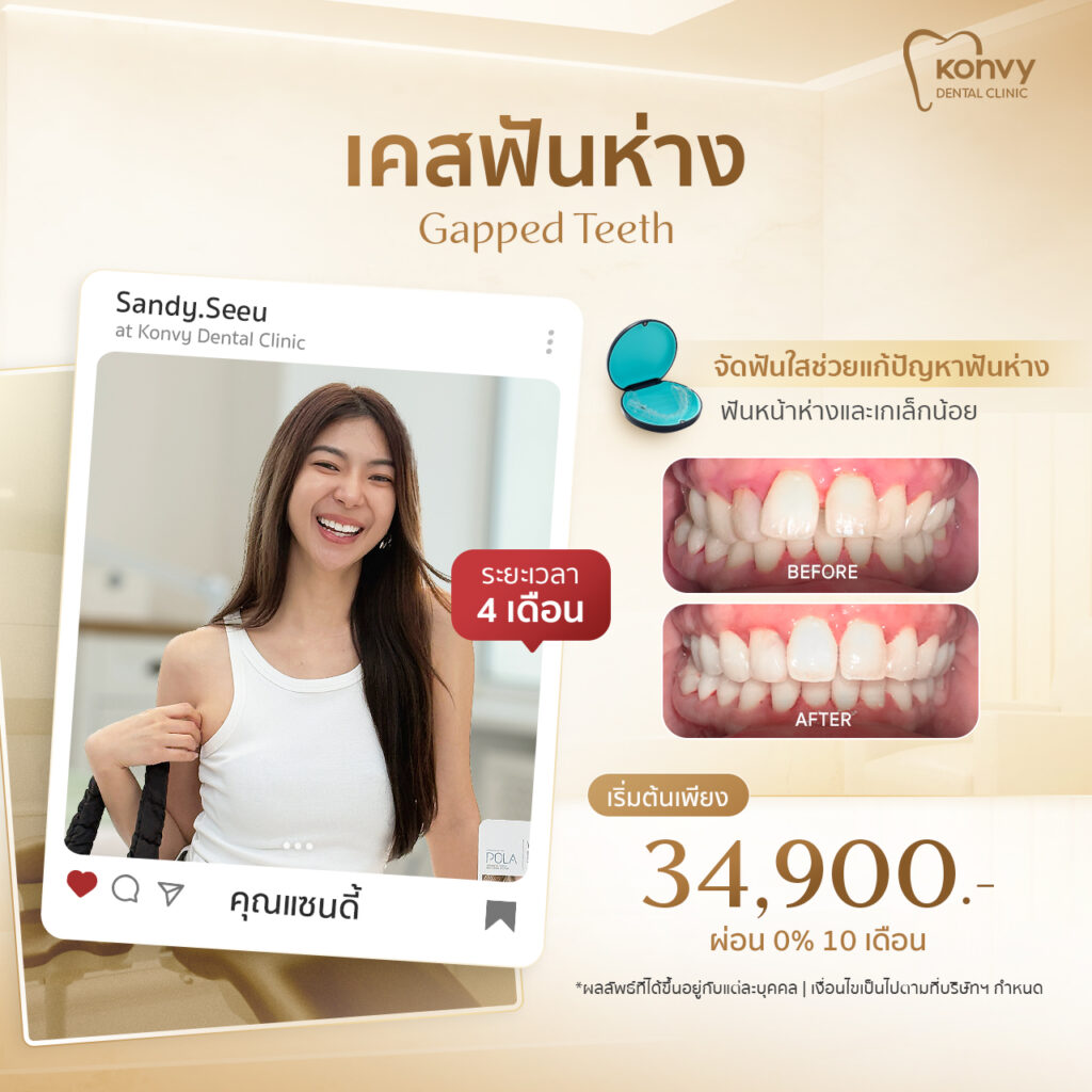 ฟันเรียงสวย ที่ Konvy Dental Clinic